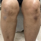 The patient presented with patches that were dark brown, thin, and symmetrically distributed.