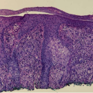 Biopsy of right nasal lesion demonstrating pseudocarcinomatous hyperplasia with noncaseating granulomas.