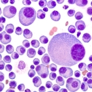 multiple myeloma