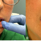 The patient presents with hyperpigmented macules on the lips, tongue, buccal mucosa, and gingiva.