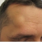 image of a lump on a man's forehead