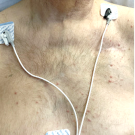 Diffuse pink perifollicular papules on the chest.