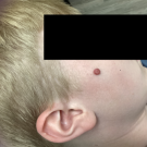 A 0.8 cm pink, dome-shaped papule with irregular borders on the right central zygoma