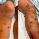 Discrete keratotic, pustular papulonodular lesions with central necrotic crust in differing stages of healing on the lower extremities.