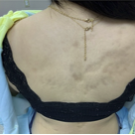 Figure 1A-C. Lesion presentation of suspected atrophoderma of Pasini and Pierini is shown.