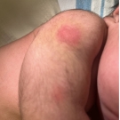 Two subcutaneous nodules were noted on the lateral right deltoid