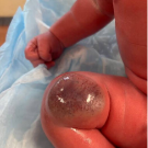 Infant with a 5 × 5 × 2 cm, well-circumscribed, violaceous lesion on the right posterior thigh