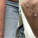 This image presents flesh to white-colored, firm verrucous papules of the right arm.