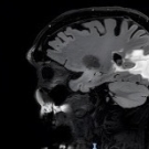Sagittal T2-weighted FLAIR MRI demonstrating extensive hyperintense signal within the right occipital and posterior parietal white matter that is consistent with vasogenic edema surrounding the lesion with mild local mass effect. 