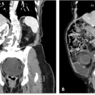 The CT of the abdomen and pelvis with contrast shows right hydronephrosis and hydroureter, (A) coronal view, (B) sagittal view