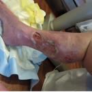 An image of the patient’s right lower extremity wounds at the time of admission.