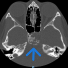 Initial computerized tomography. The maxillary sinus imaging revealed a suprasellar mass (arrow) is shown.