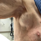 A presentation of right axillary mass is shown.