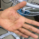 erythematous, serpiginous, slightly raised linear tract with irregular borders on the palmar surface