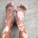 Vitiligo on feet