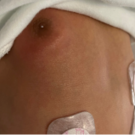 Figure 1A-C. Erythema overlying right subareolar gynecomastia, with minimal white nipple discharge (A, B). Bilateral subareolar gynecomastia, right greater than left (C).