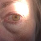 Still photo of pseudophakia video