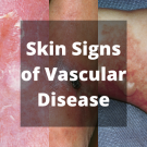 Skin signs of vascular disease