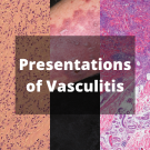 vasculitis
