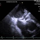 Still photo of Caught in the Act: Thrombus Straddling a Patent Foramen Ovale, Video 1