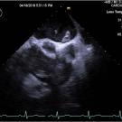 Transesophageal echocardiography showed the presence of thrombi in all 4 chambers of the heart.