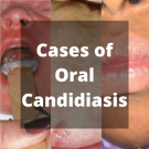 oral candidiasis