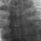 Still photo of thrombectomy video 1