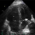 Still photo of thrombectomy video 2