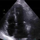 Still photo of thrombectomy video 3