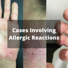Allergic Reactions