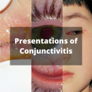 Presentations of Conjunctivitis