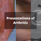 Arthritis slideshow