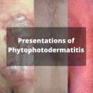 phytophotodermatitis