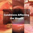 Conditions Affecting the Mouth