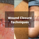 wound closure techniques
