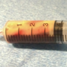 hypertriglyceridemia-induced acute pancreatitis