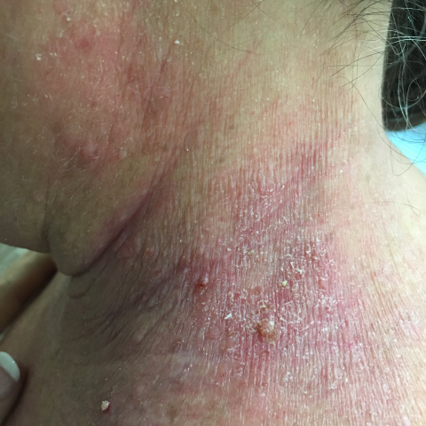 Slideshow: Cases Involving Allergic Reactions