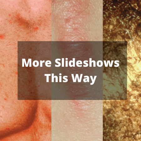 Slideshow: Presentations of Cutaneous Manifestations of Steroid Use