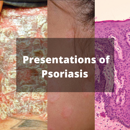Presentations of Psoriasis