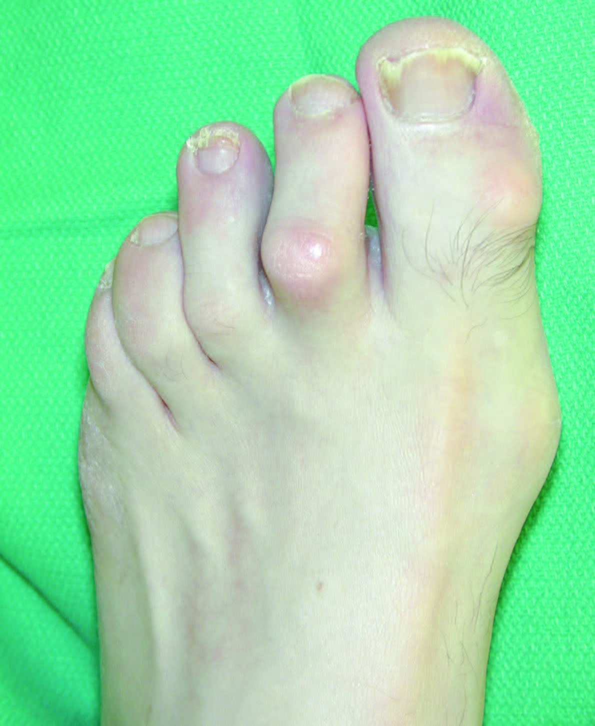 Re-evaluating The Plantar Plate