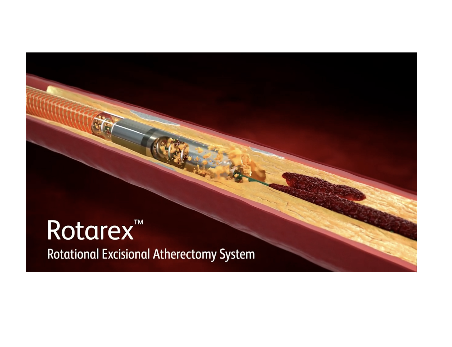 Experiences in Treating Complex Lesions with Rotarex™ Atherectomy System