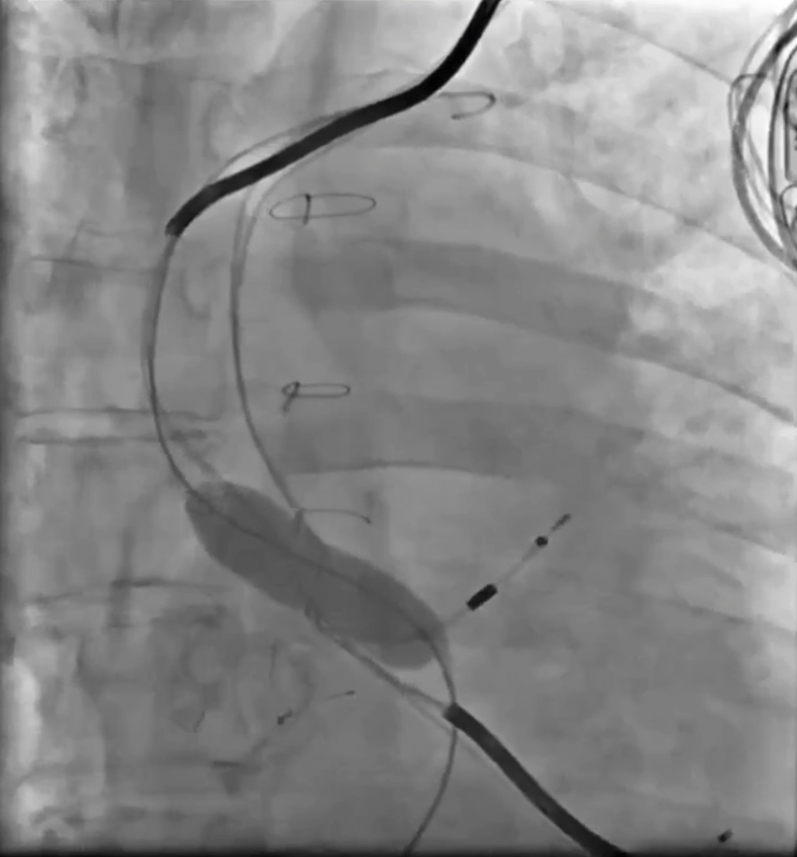 Mastering Icd 10:  Navigating Calcified Pulmonary Granuloma Codes - 59kx1ik