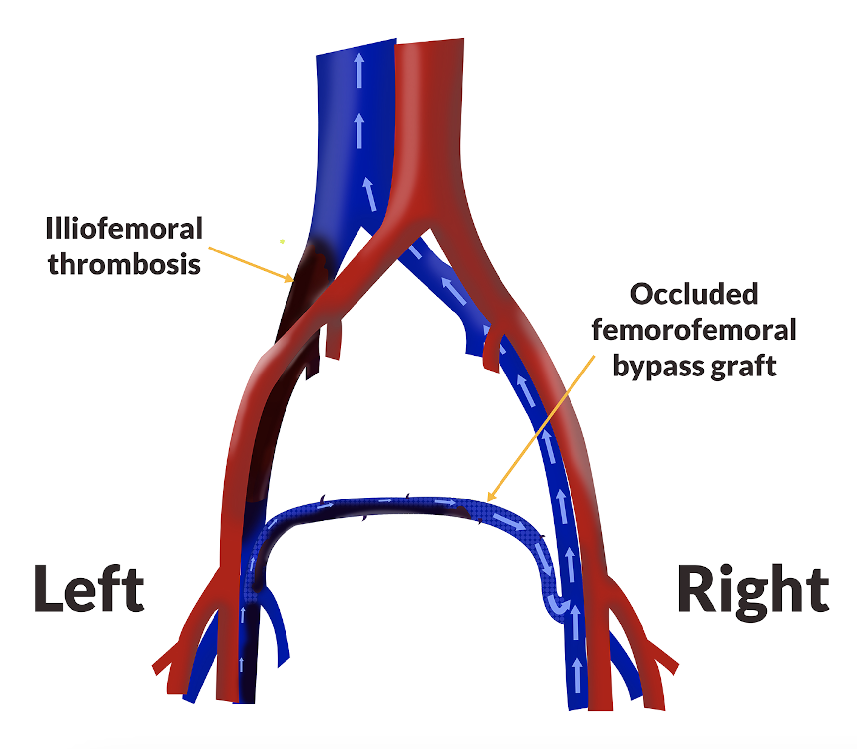 Occluded Femorofemoral Venous Bypass Graft | VDM