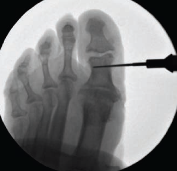 Medially Based Hallux Interphalangeal Joint Arthroplasty in the ...