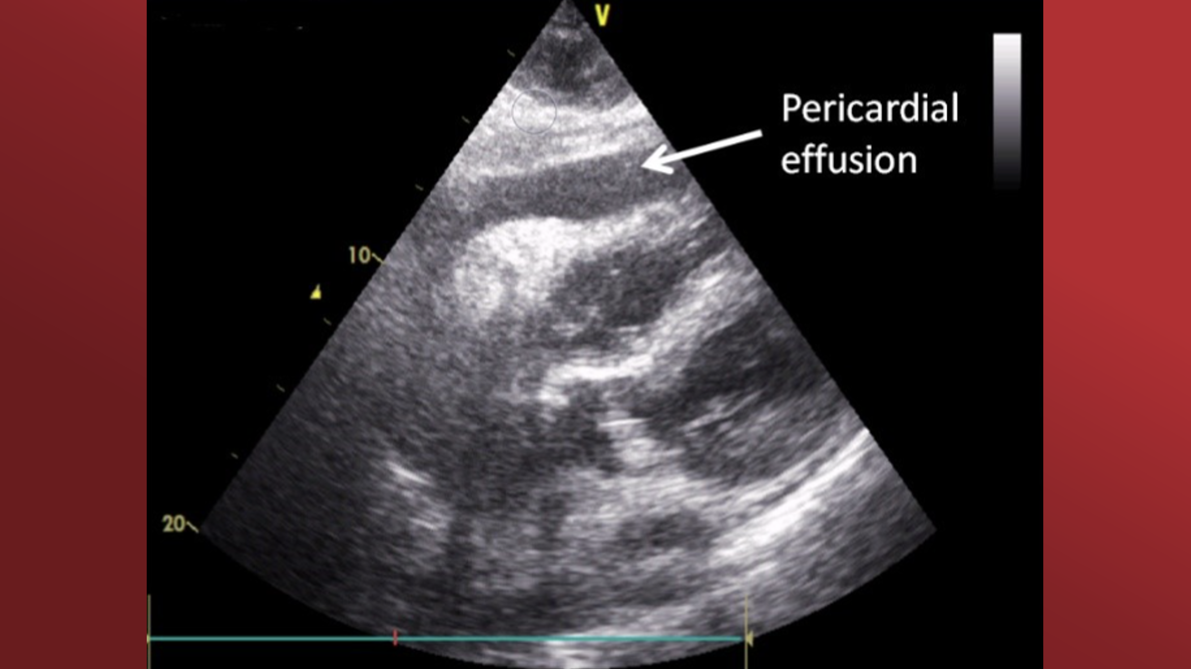 External Haemo Intrapericardial Blood Re-transfused to Venous Circulation Through a ...
