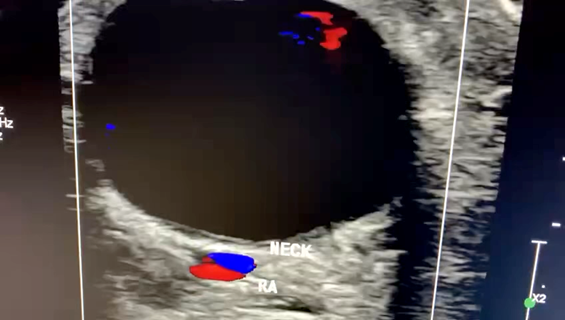 Radial Artery Pseudoaneurysm Rupture After Cardiac Catheterization