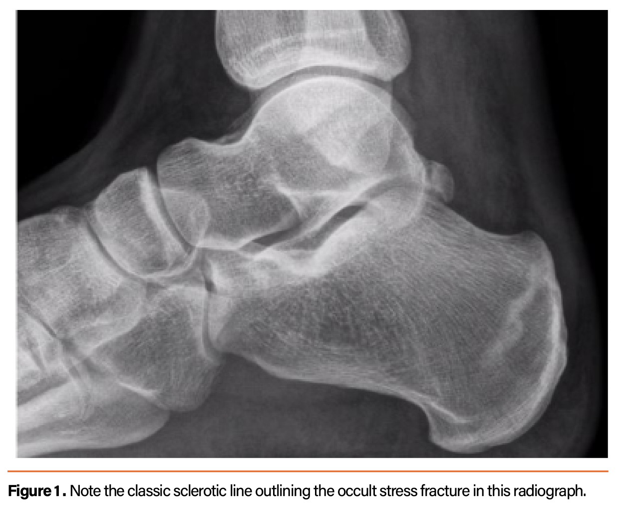 Stress Fracture Heel Boot At Mark Jennings Blog Stress Fracture Heel Boot At Mark Jennings Blog