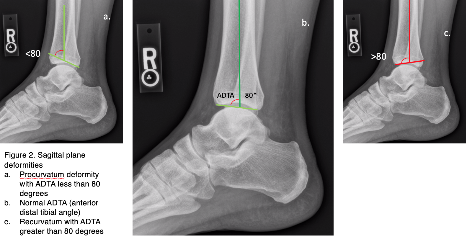 Ankle Deformities In Athletes Looking Beyond Arthritis Podiatry Today