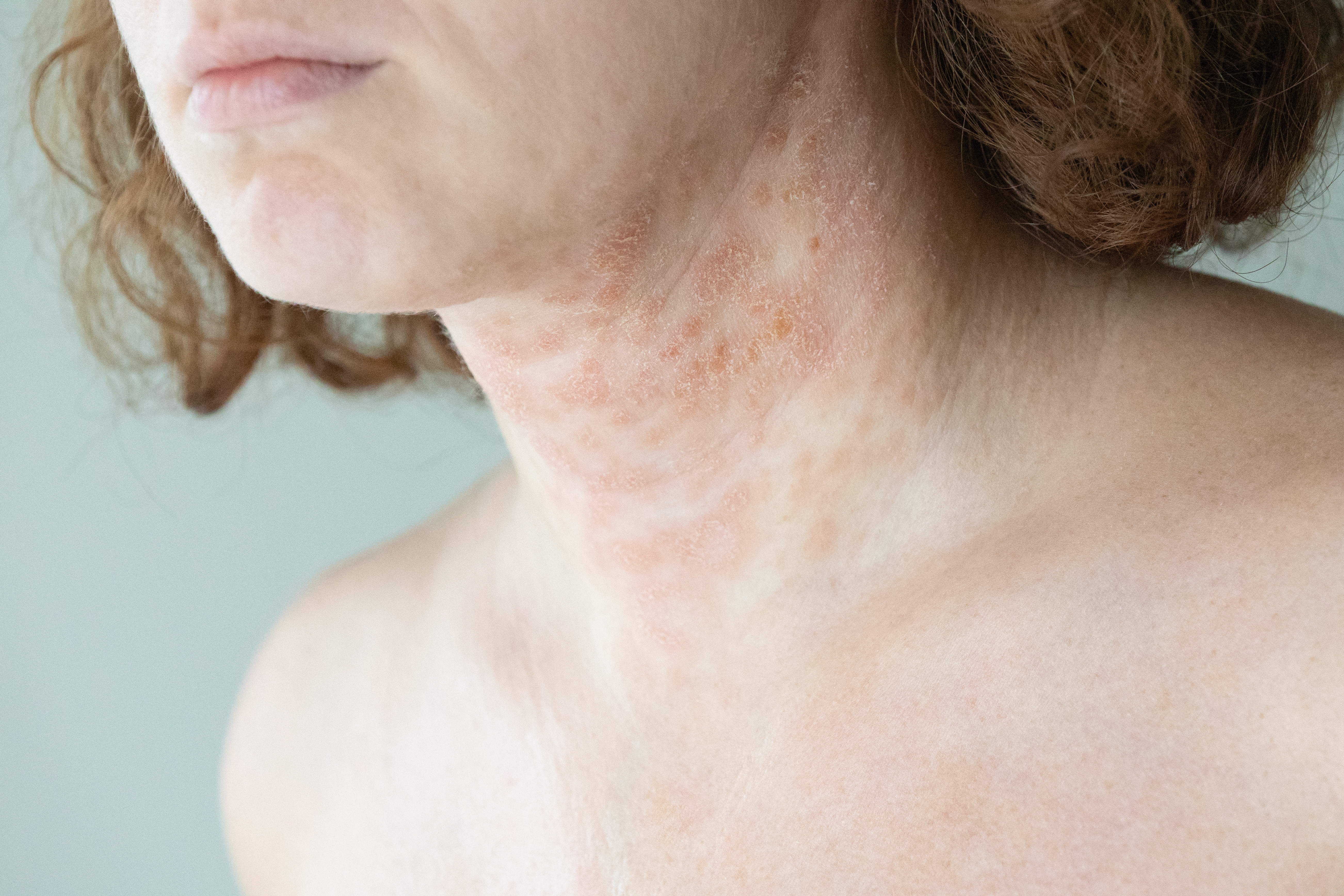 atopic dermatitis