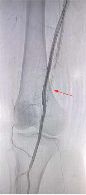 Figure 3. Final result, demonstrating an open percutaneous femoral popliteal bypass.